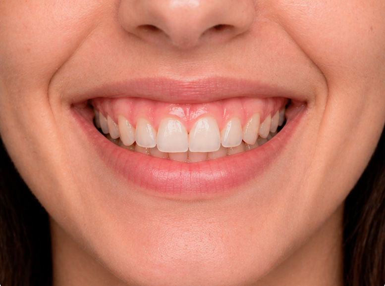 GINGIVAL-1